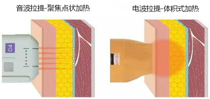 電波拉提,電波拉提原理,電波拉提作用