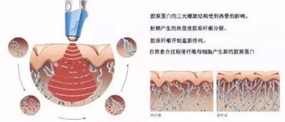 減肥/抗衰兩不誤，BTL溶脂刀儀器一次滿足你