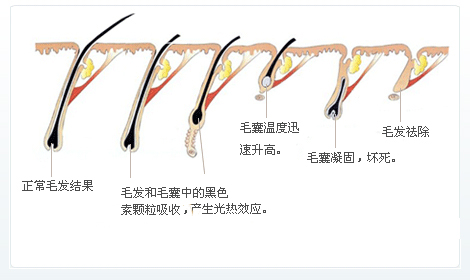 脫毛為什么一次性脫不干凈？原因在這里