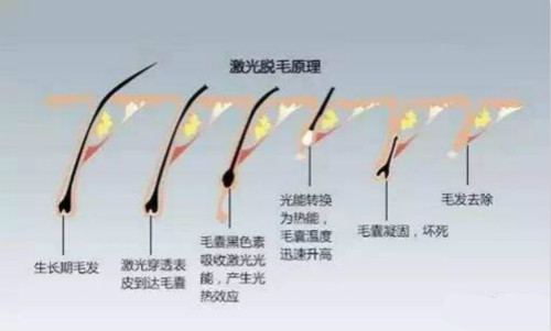 激光脫毛原理