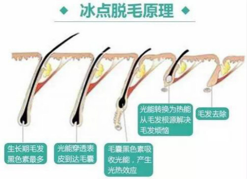 冰點脫毛原理