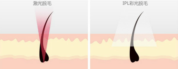 激光脫毛儀和IPL彩光脫毛儀的區(qū)別