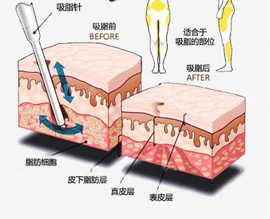 用核磁儀器爆脂減肥？只是一個(gè)噱頭而已