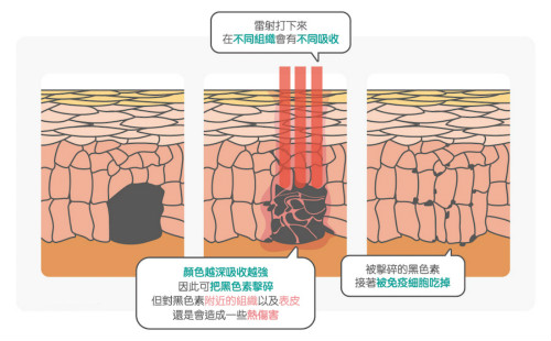 激光儀器美白淡斑：凈膚激光、粉餅激光、光纖激光比較及注意事項(xiàng)