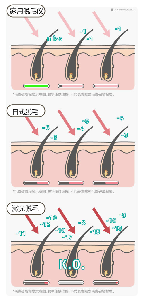 日式脫毛、家用脫毛儀及激光脫毛的功效價(jià)格大評(píng)比