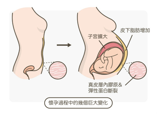 一文秒懂！妊娠紋肥胖紋保養(yǎng)、治療及預(yù)防全攻略