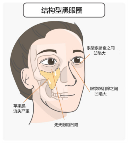 區(qū)分黑眼圈！黑眼圈的成因、分類、預(yù)防與治療全攻略