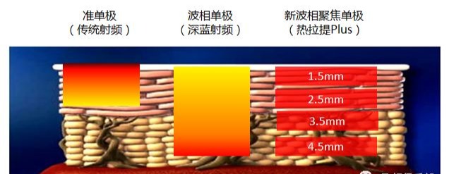 射頻醫(yī)美抗衰發(fā)展史！射頻美容儀到底哪里好？