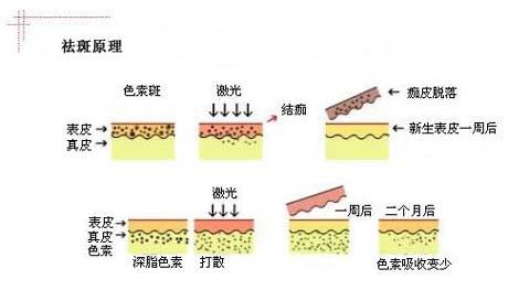 激光祛斑原理