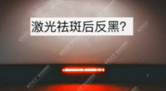 激光祛斑之后皮膚會反黑？美容儀器廠家教你這樣預防