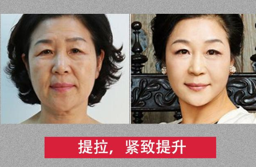 小氣泡美容儀器深層潔膚治療過程