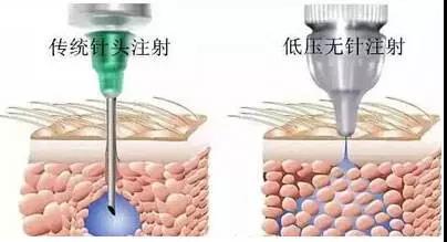 無創(chuàng)水光儀的出現(xiàn)可否取代水光針的治療呢